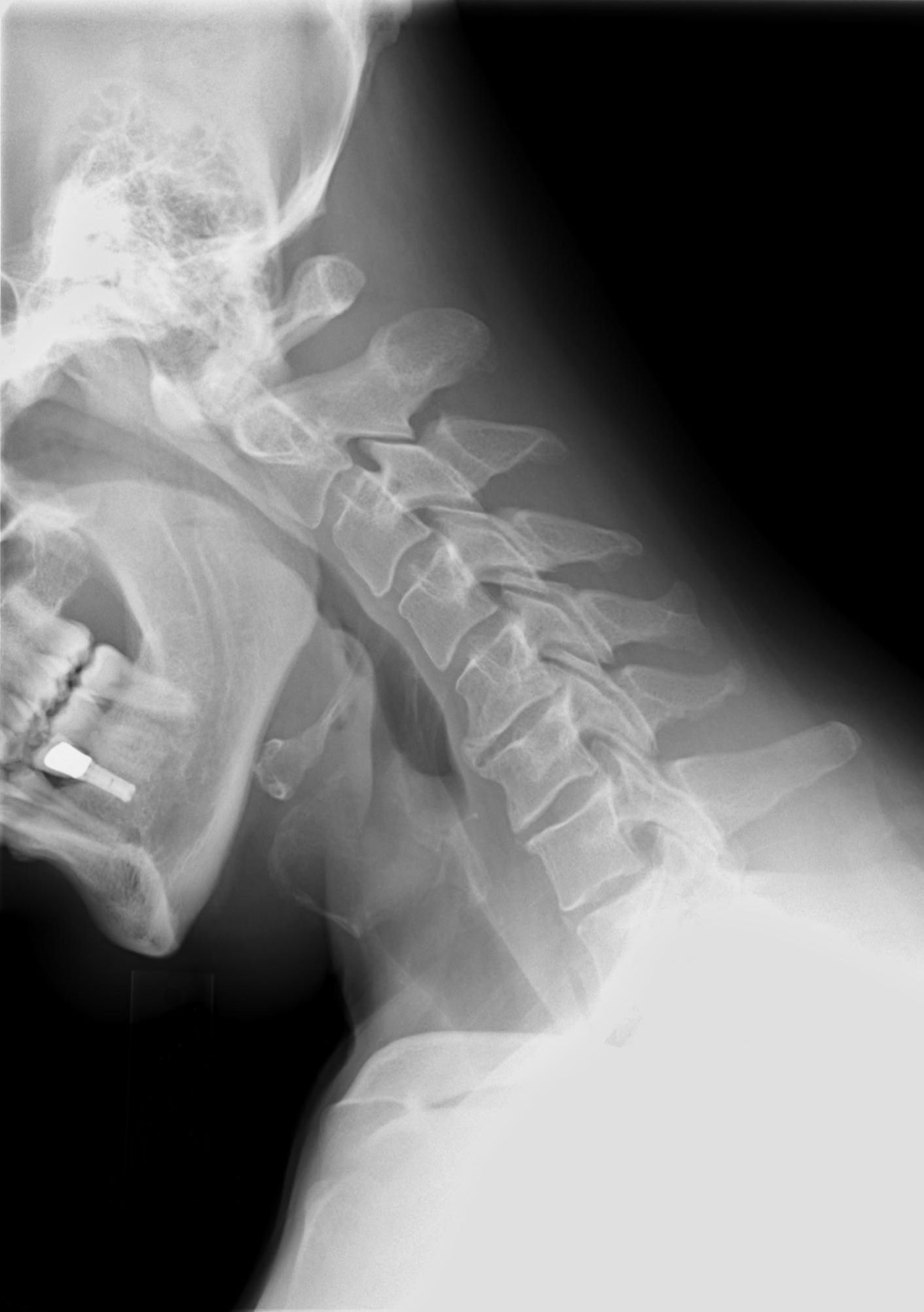 Cervical_Xray_Extension_view
